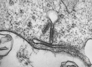 M, 1y. | histiocytosis X (eosinophilic granuloma) - Birbeck bodies